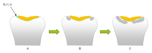 治療した歯が虫歯になるプロセス